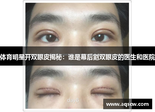 体育明星开双眼皮揭秘：谁是幕后割双眼皮的医生和医院